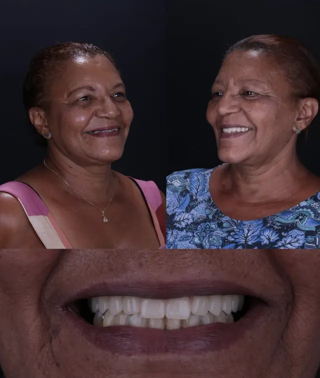 Paciente antes e depois da reabilitação do sorriso