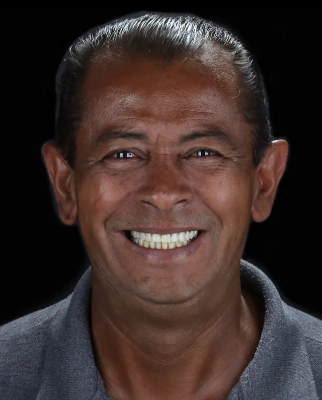 Paciente sorrindo após reabilitação oral