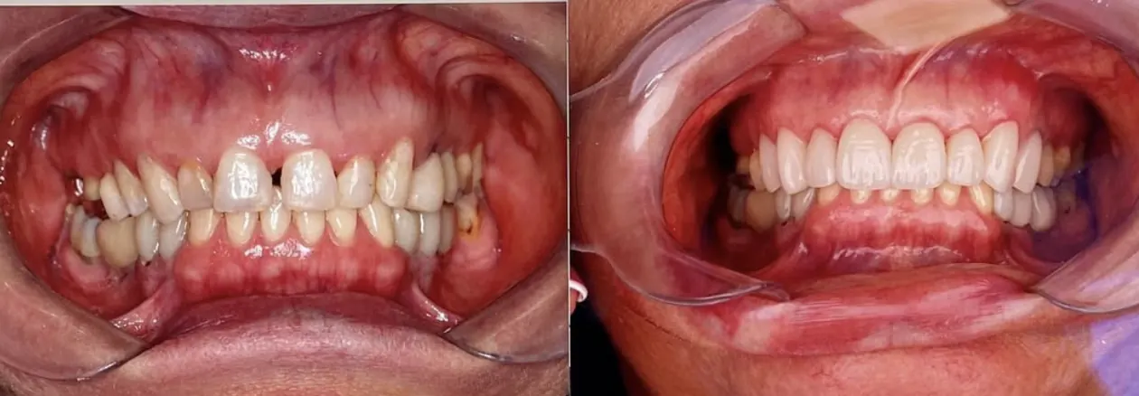 Vista intraoral antes e depois do tratamento