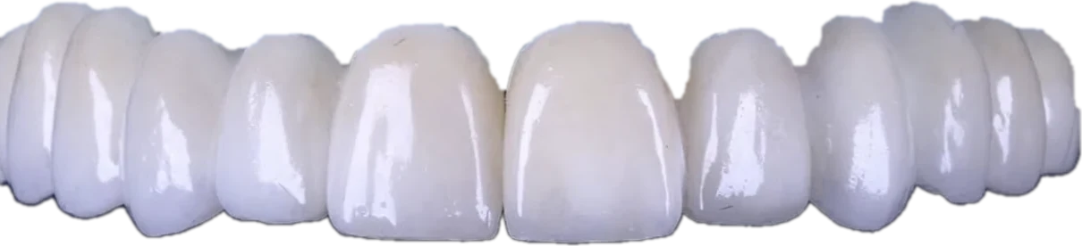 Prótese fixa sobre implantes